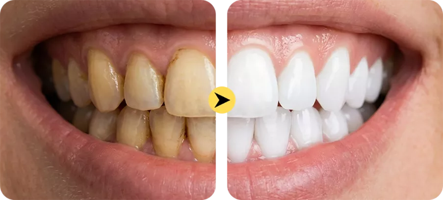 Instant Whitening Tooth Paint